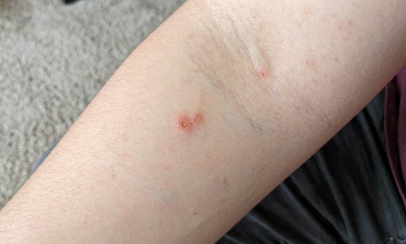 Close-up of a forearm with two small red, irritated skin spots